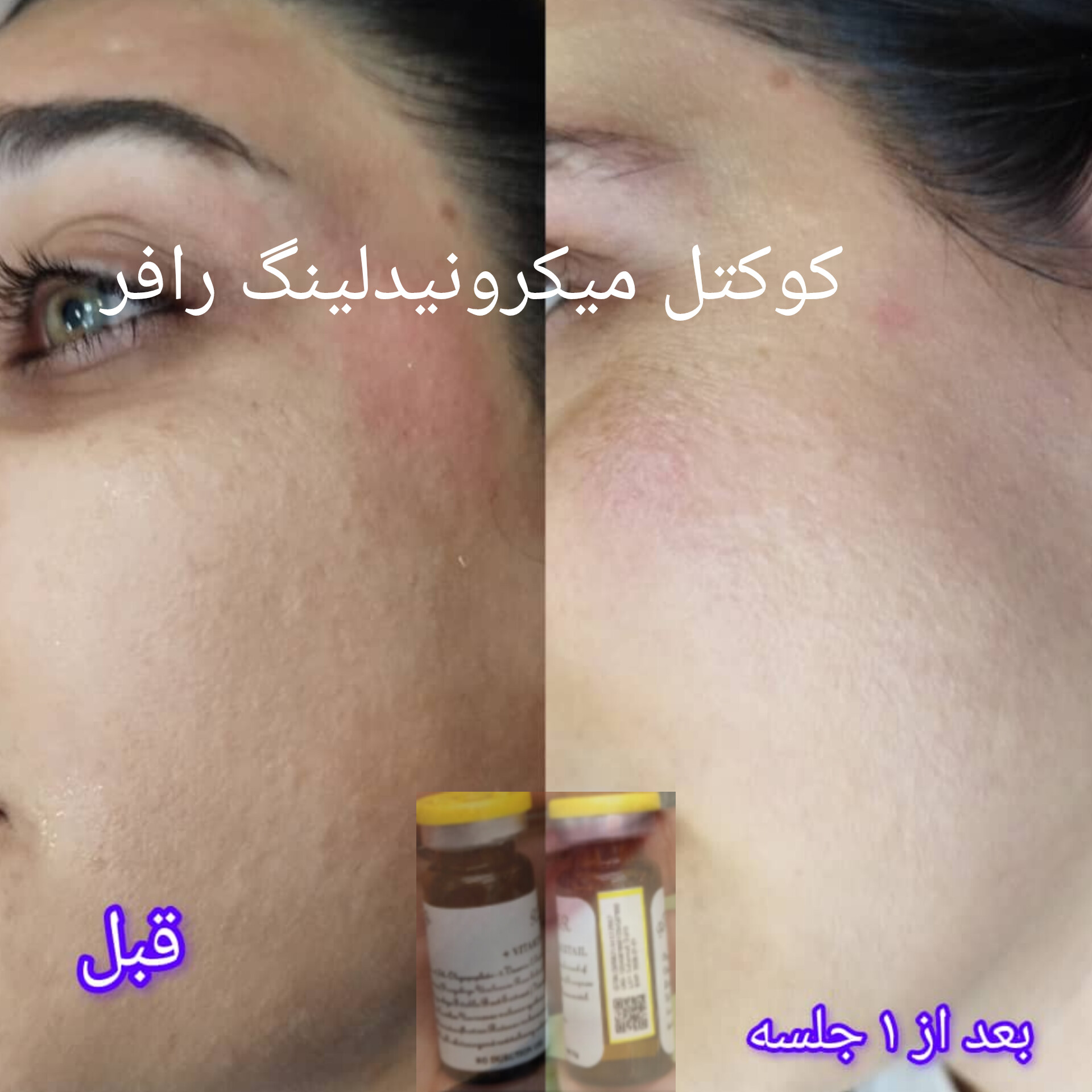 کوکتل نیدلینگ رافر ۱ جلسه ای